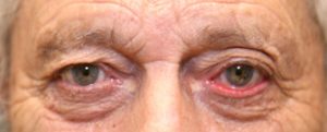 Blepharoplasty