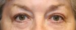 Blepharoplasty