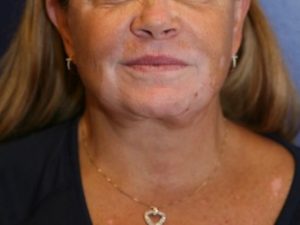 Neck Lift Case 901 After Photo Neck Lift