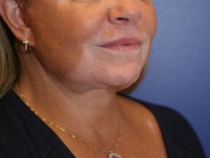 Neck Lift Case 901 After Photo Neck Lift