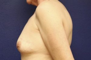 Breast Augmentation Case 931 Before Photo Breast Augmentation