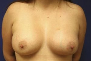 Breast Augmentation