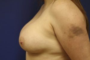 Breast Augmentation