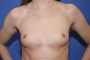 Breast Augmentation