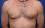 Gynecomastia