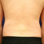 Liposuction
