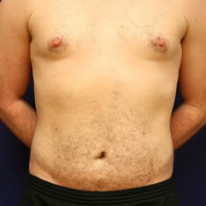 Liposuction