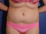 Mommy Makeover Liposuction Results Great Falls