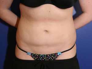 Liposuction