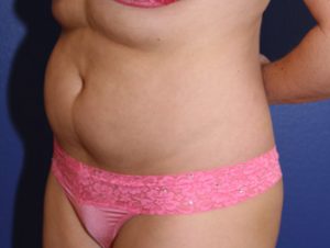 Liposuction