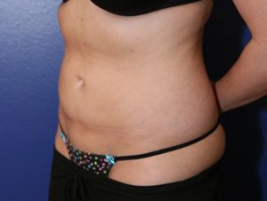 Liposuction