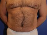 Liposuction