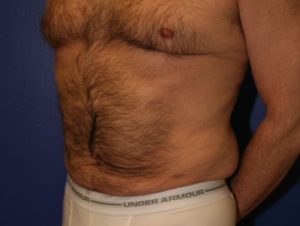 Liposuction Case 1046 After Photo Liposuction