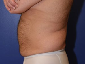Liposuction Case 1046 Before Photo Liposuction