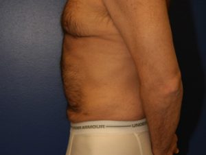 Liposuction Case 1046 After Photo Liposuction