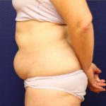Mommy Makeover Tummy Tuck Results Great Falls