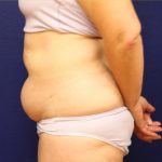 Tummy Tuck