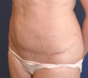 Tummy Tuck Case 1061 After Photo Tummy Tuck