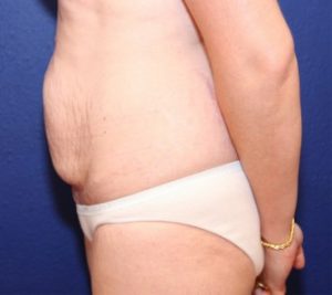 Tummy Tuck Case 1061 Before Photo Tummy Tuck