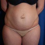 Tummy Tuck