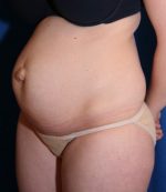 Tummy Tuck