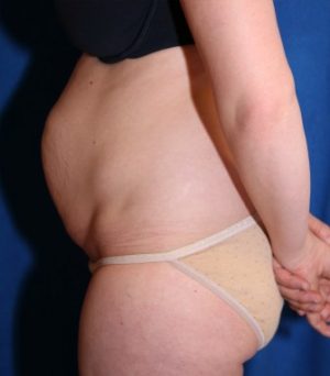 Tummy Tuck