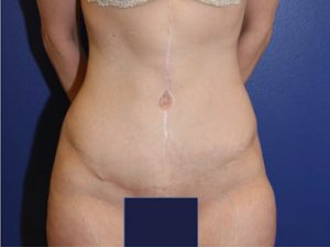 Tummy Tuck Case 1077 After Photo Tummy Tuck