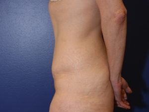 Tummy Tuck Case 1077 After Photo Tummy Tuck