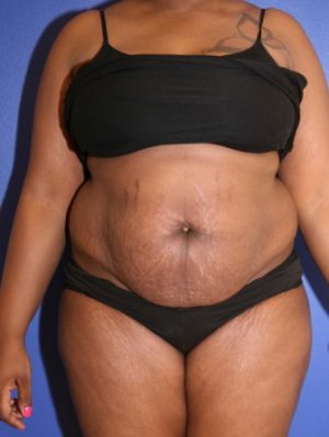 Tummy Tuck