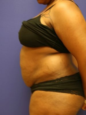 Tummy Tuck