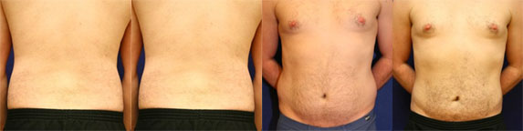 Liposuction Results Great Falls Montana