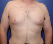 Gynecomastia