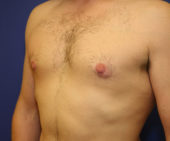 Gynecomastia