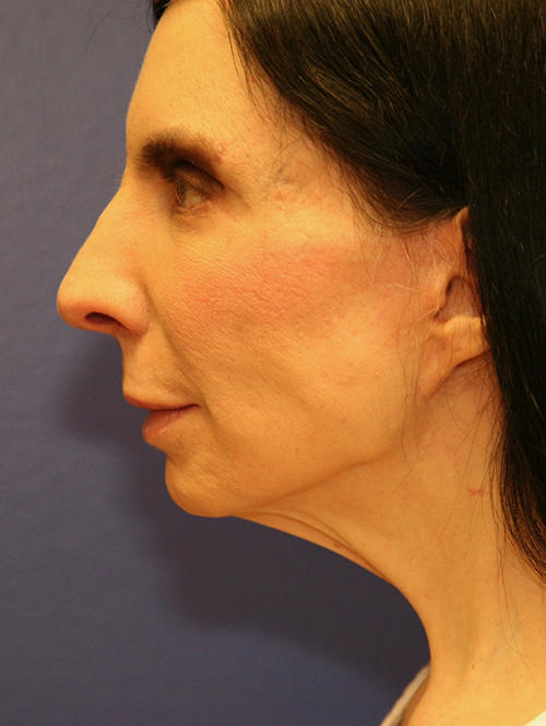 Facelift Case 1756 After Photo Facelift