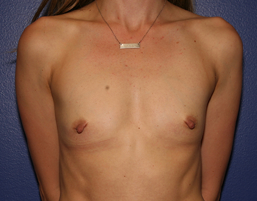 Breast Augmentation Case 1764 Before Photo Breast Augmentation