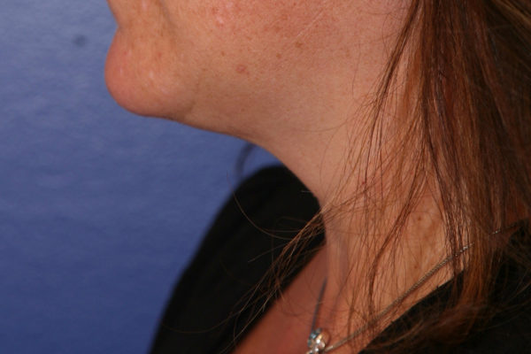 Chin Case 1796 After Photo Chin