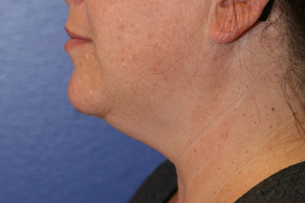 Chin Case 1796 Before Photo Chin