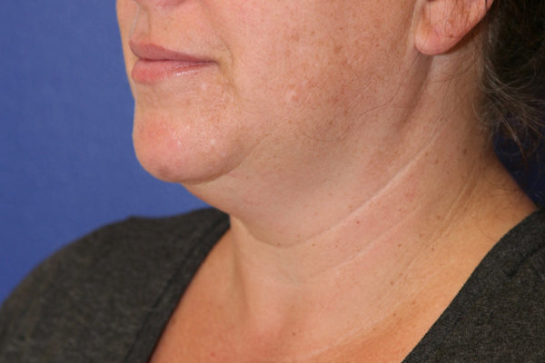 Chin Case 1796 Before Photo Chin