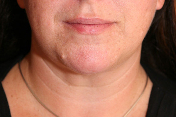 Chin Case 1796 After Photo Chin