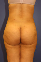 Brazilian Butt Lift Results Great Falls, Helena, Missoula, and Cascade County