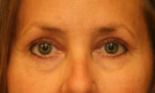 Blepharoplasty