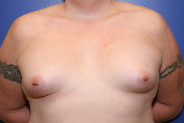 Breast Augmentation Case 1908 Before Photo Breast Augmentation