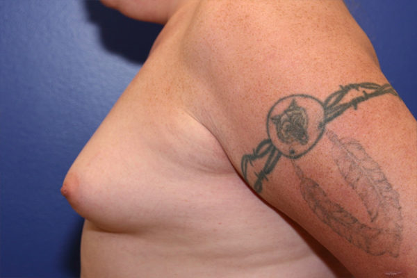Breast Augmentation Case 1908 Before Photo Breast Augmentation
