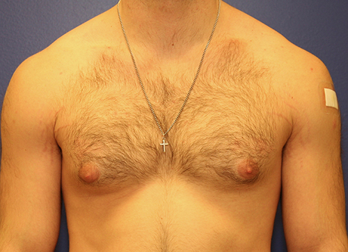 Gynecomastia Case 1917 Before Photo Gynecomastia