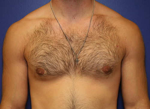 Gynecomastia Case 1917 After Photo Gynecomastia
