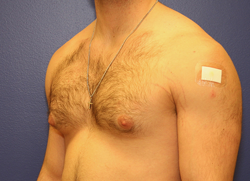 Gynecomastia Case 1917 Before Photo Gynecomastia