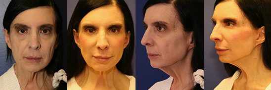 Facelift Results Great Falls Montana