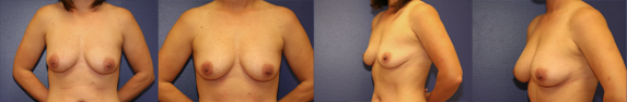 Fat Transfer to Breast Patient Gallery Case Example